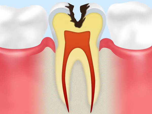 C2　象牙質の虫歯