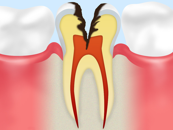 C3　神経まで達した虫歯