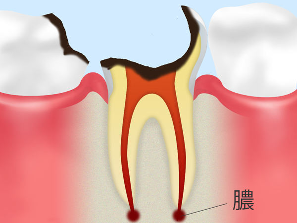 C4　歯の根まで達した虫歯