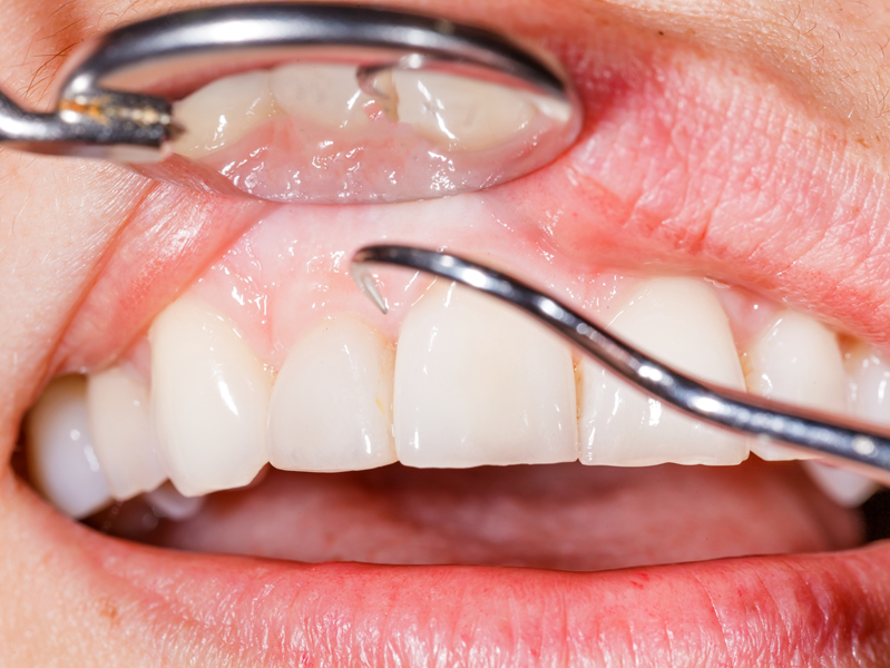 5. 歯ぐきの状態を整える（歯周病の治療）