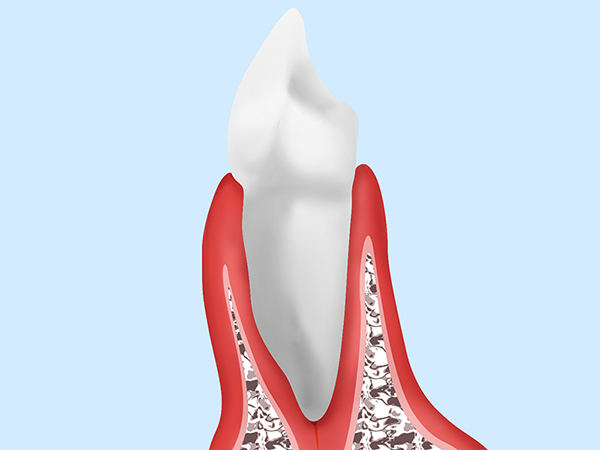 1.歯ぐきが赤く腫れる（歯肉炎）