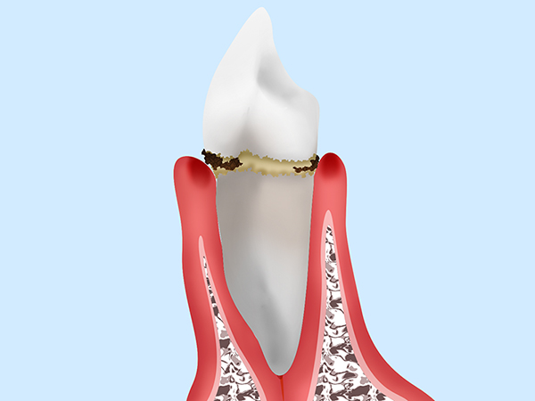2. 初期の歯周炎