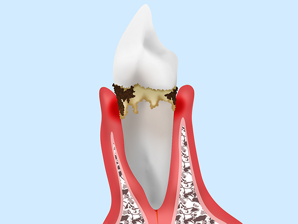 3. 中期の歯周炎