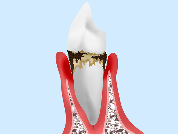 4. 重度の歯周炎