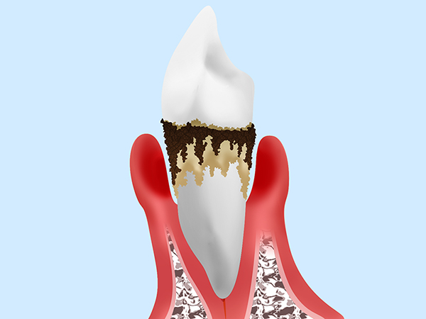 5. 末期の歯周炎